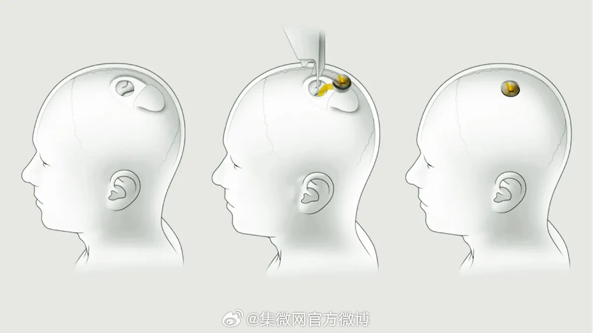脑控芯片最新取出技术，心灵与自然的奇妙之旅